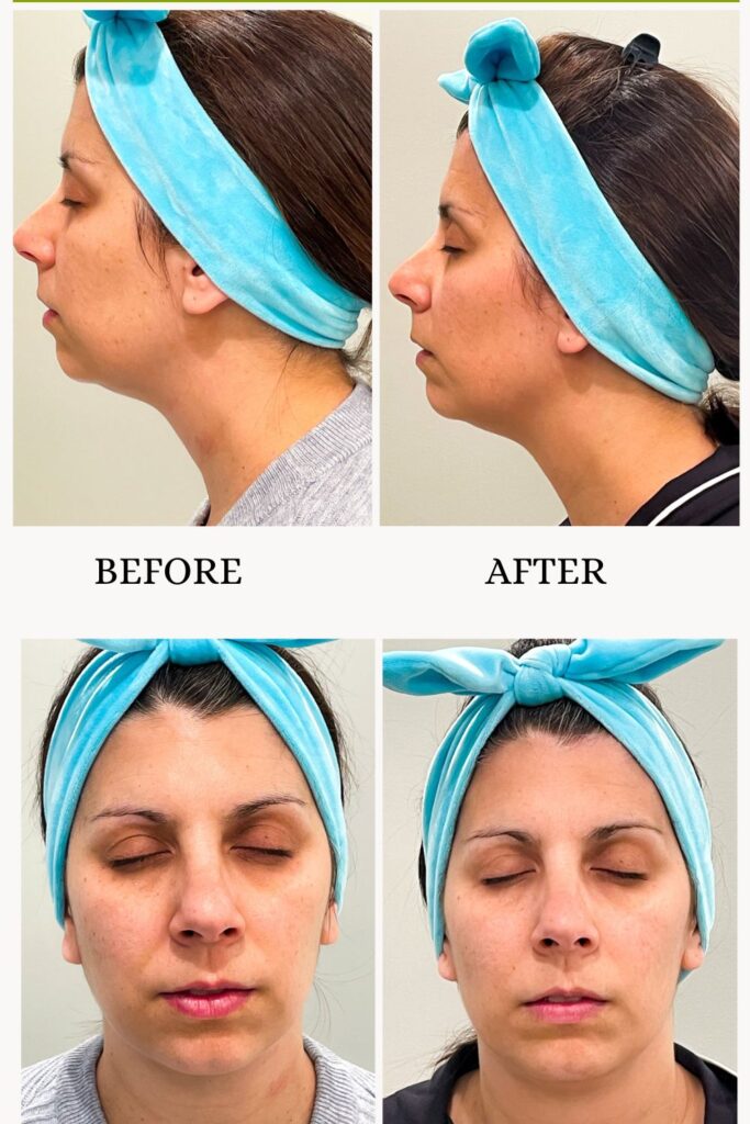 woman showing results of her nuface trinity review
